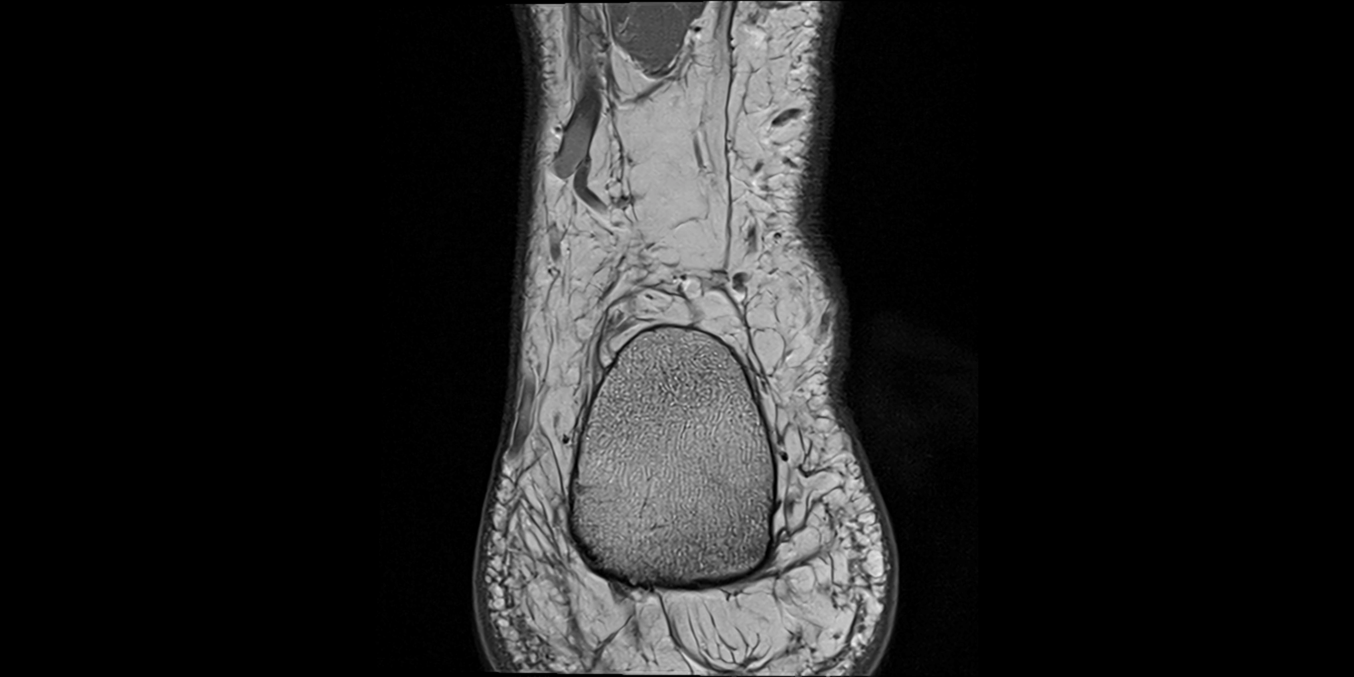 MRI Ankle coronal ligaments cross sectional anatomy 3T  radiology  image-img-00001-00028.webp